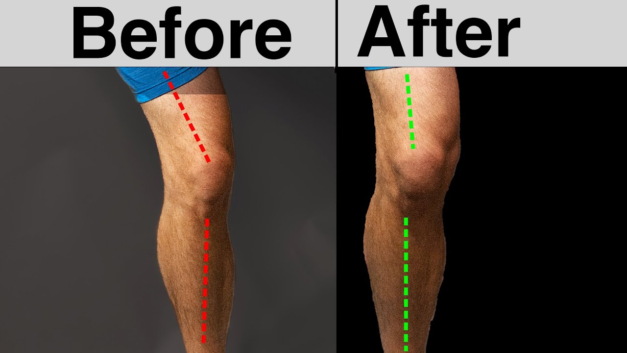 Fix Your Knee Caving in FOR GOOD