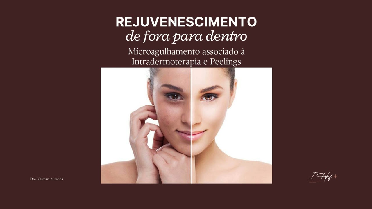Harmonização Facial IHof+ By Dra. Gismari Miranda @dra.gismari