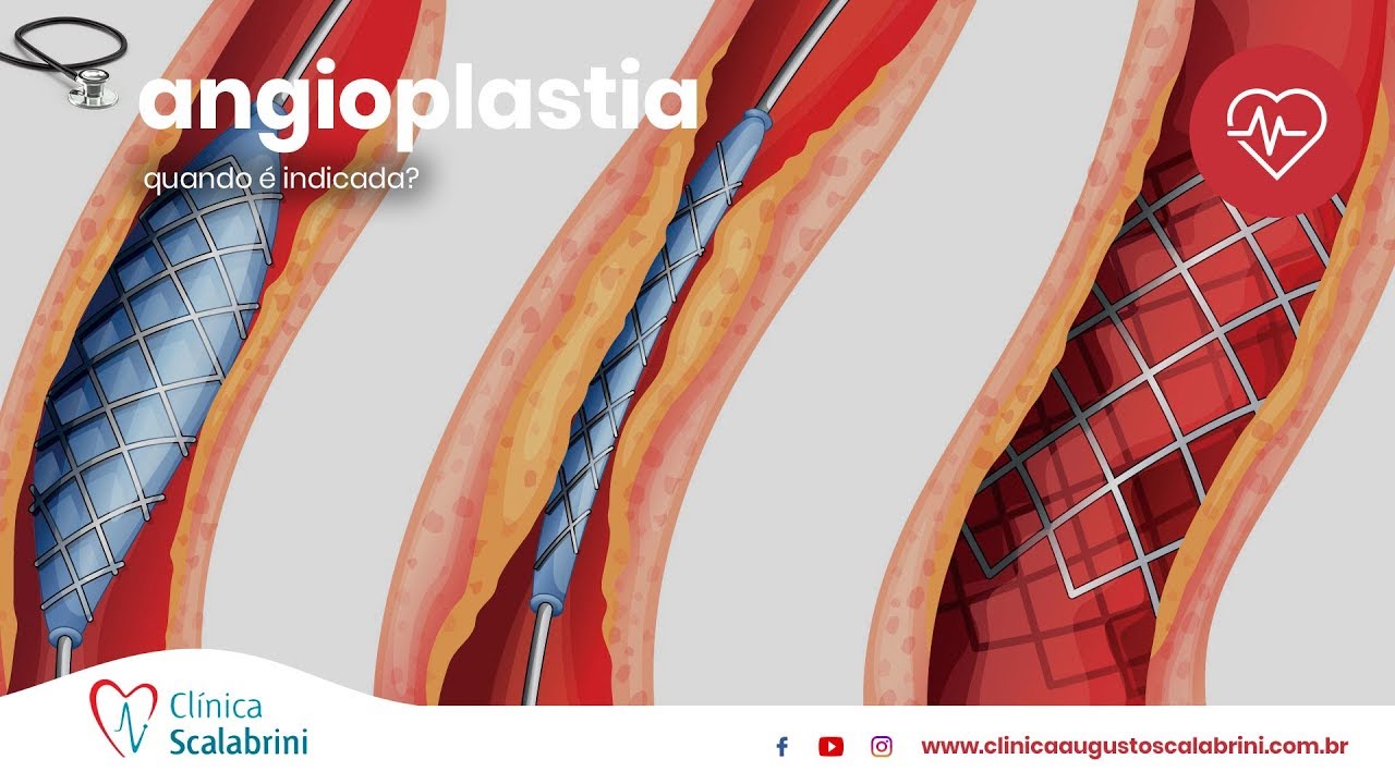 Quando é Indicada a Angioplastia