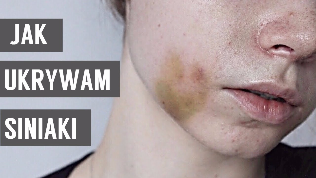 JAK UKRYWAM SINIAKI // MAKIJAŻ PO OPERACJI //