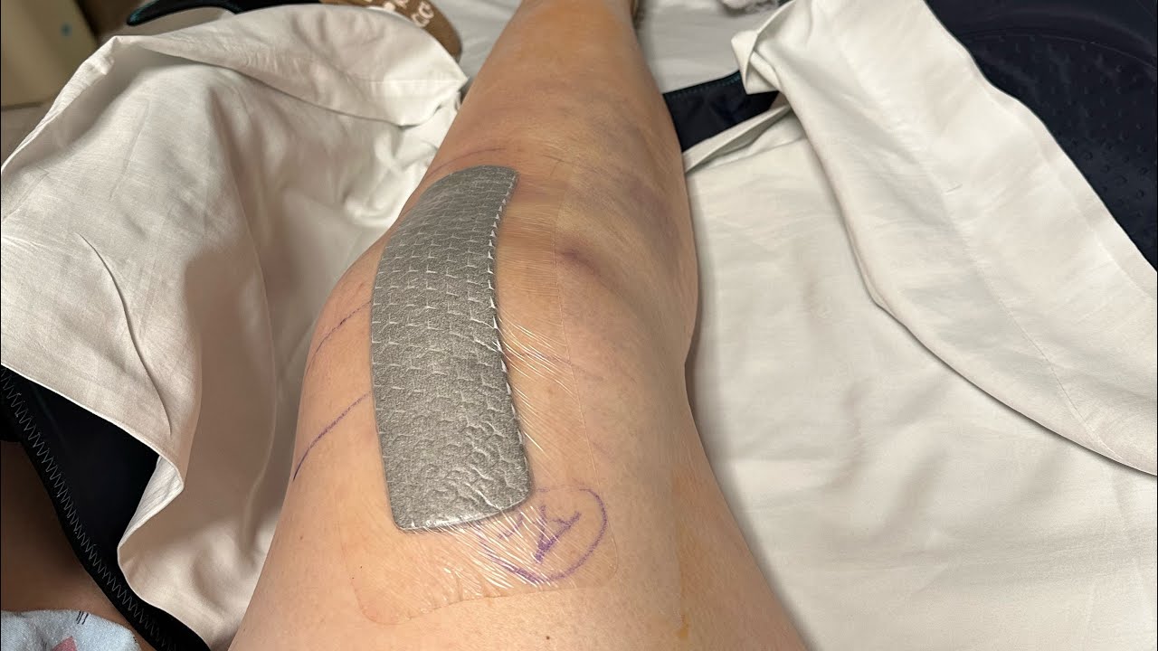 Knee replacement surgery getting in and out of bed and some PT ￼
