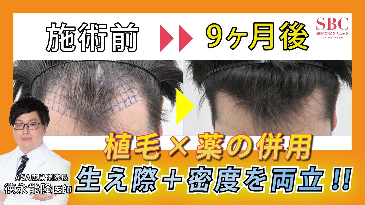 生え際は植毛、頭頂部は薬。賢く使い分ける「最小限で最大」の効果術