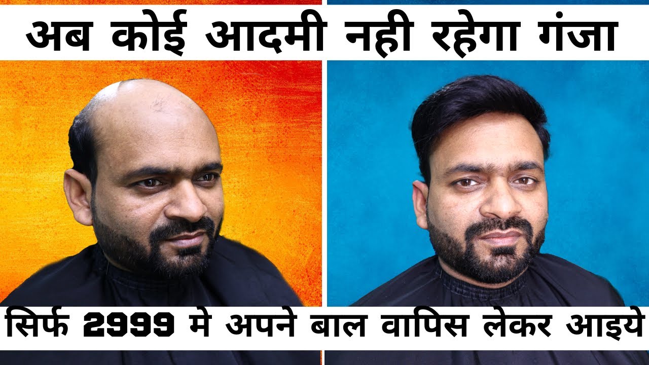HAIR PATCH IN DELHI | Best place to buy hair WIG | ganjepan ka ilaj | Born Creator