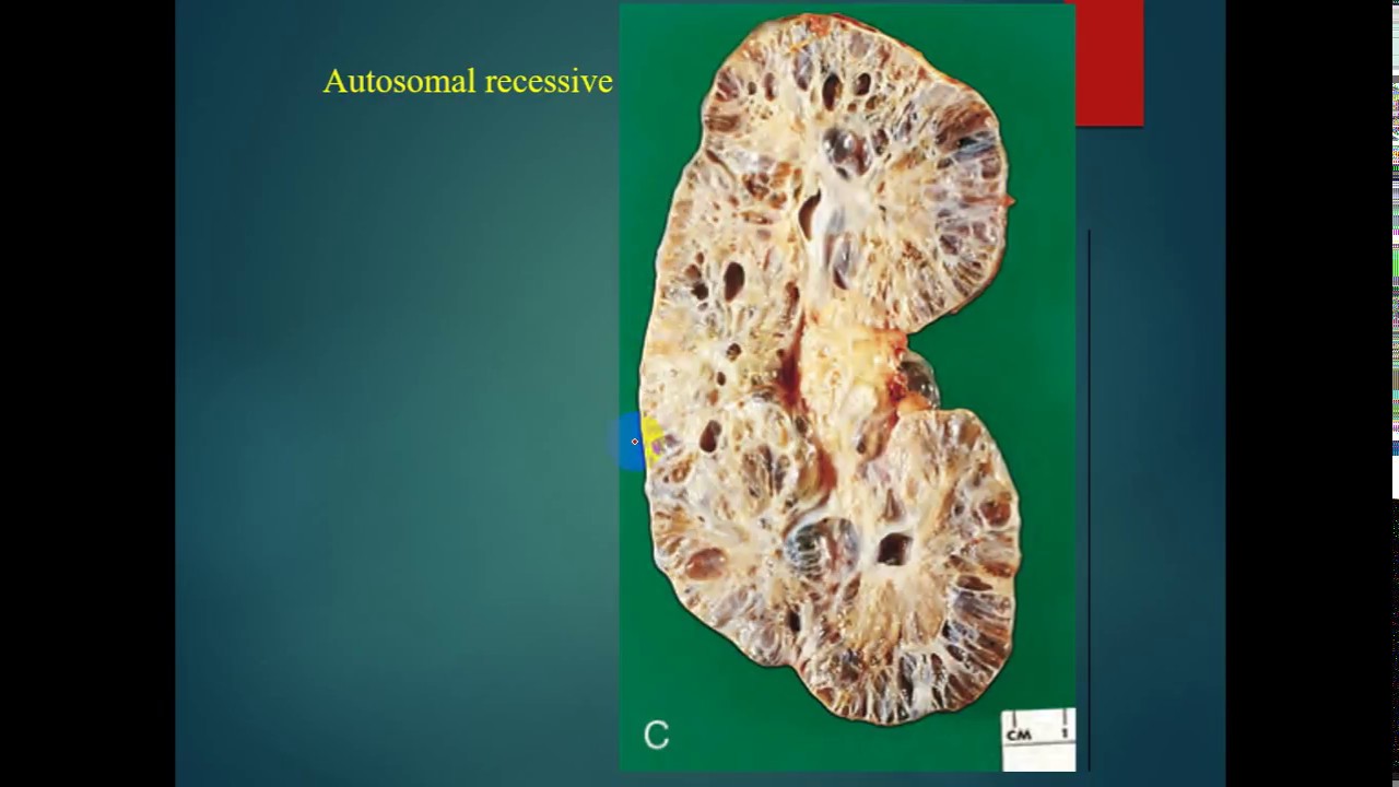 Patho - dr.  Tahseen -- Polycystic Kidney ( Adult & Infantile) & Hydronephrosis باثولوجي