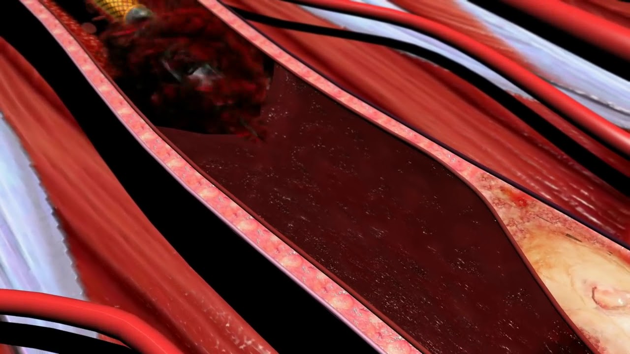 ROTAREX®S by Straub Medical AG