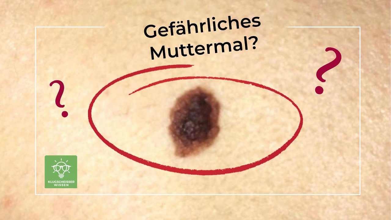 Harmloses Muttermal oder Hautkrebs?