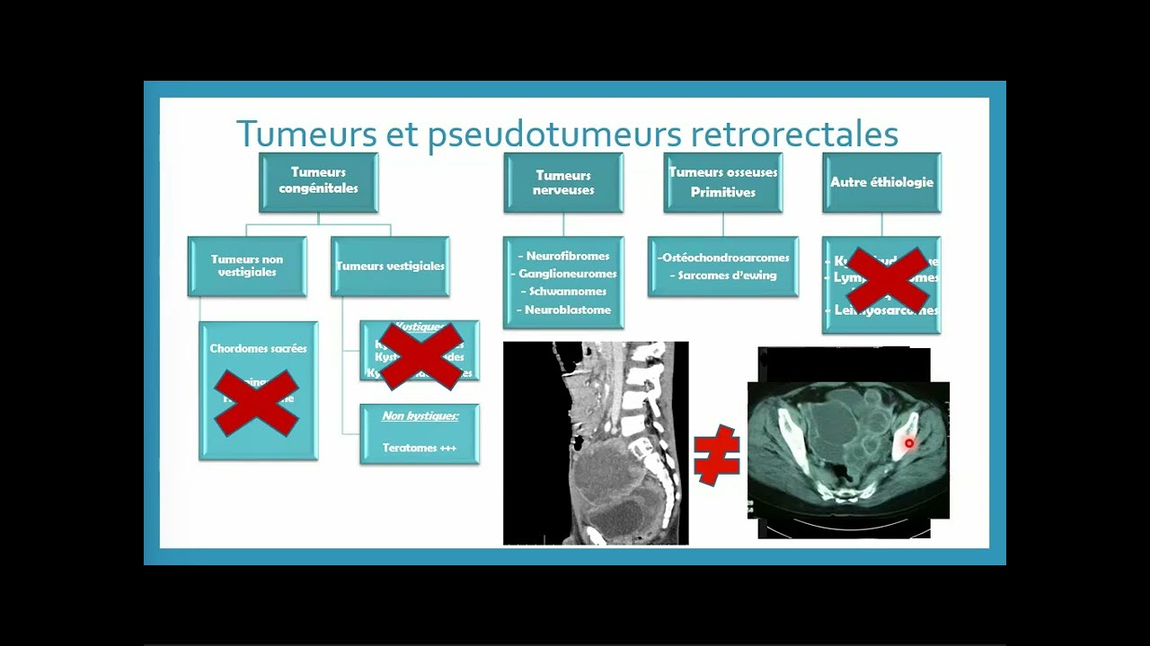 Strat&eacute;gie diagnostique devant une masse pr&eacute;-sacr&eacute;e chez l'enfant