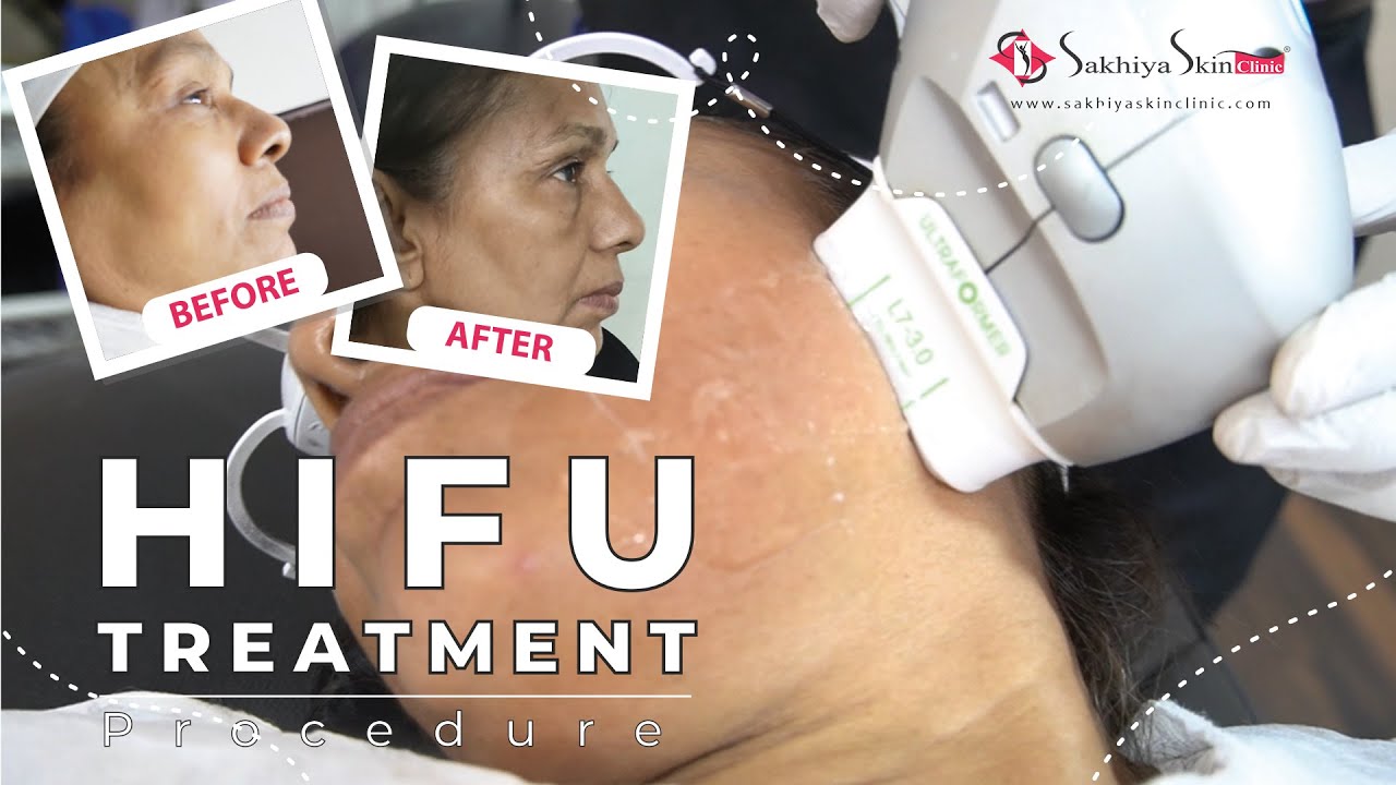Laser Skin Tightening Treatment | HIFU Procedure | Dr Jagdish Sakhiya |Sakhiya Skin Clinic