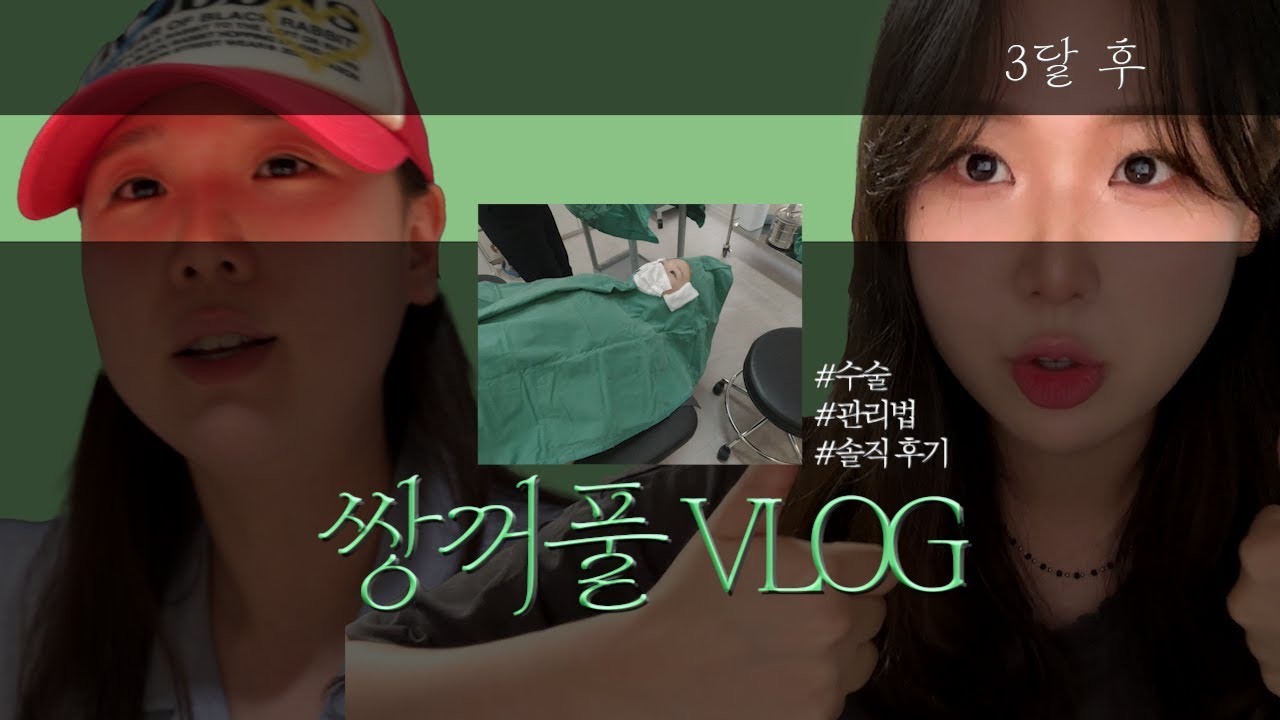 [VLOG]쌍수 브이로그📢｜앞트임+절개+눈매교정｜붓기 과정｜3개월차 솔직 후기✨