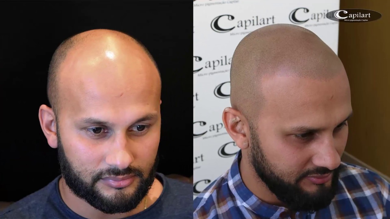 SOLUÇÃO DEFINITIVA PARA A CALVICE - Micropigmentação capilar Capilart
