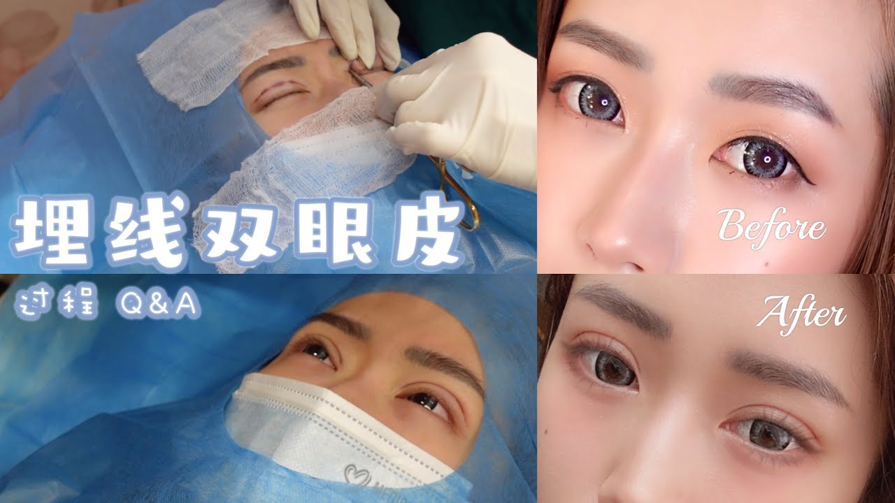 埋線雙眼皮過程 👀 【雙眼皮Q&A】多少錢？ 雙眼皮修復後第一個拍攝幕後花絮！