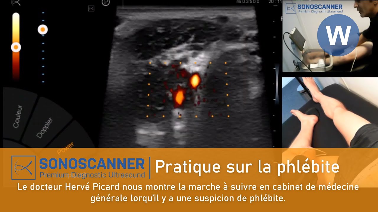 Cas pratique: recherche de phlébite avec un échographe en cabinet de médecine générale