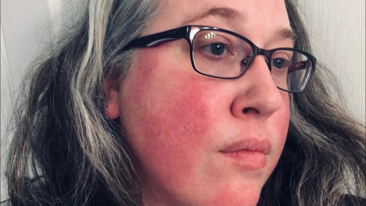 Video 1 - Introduction for @Living on Fire: Erythromelalgia & Anhidrosis