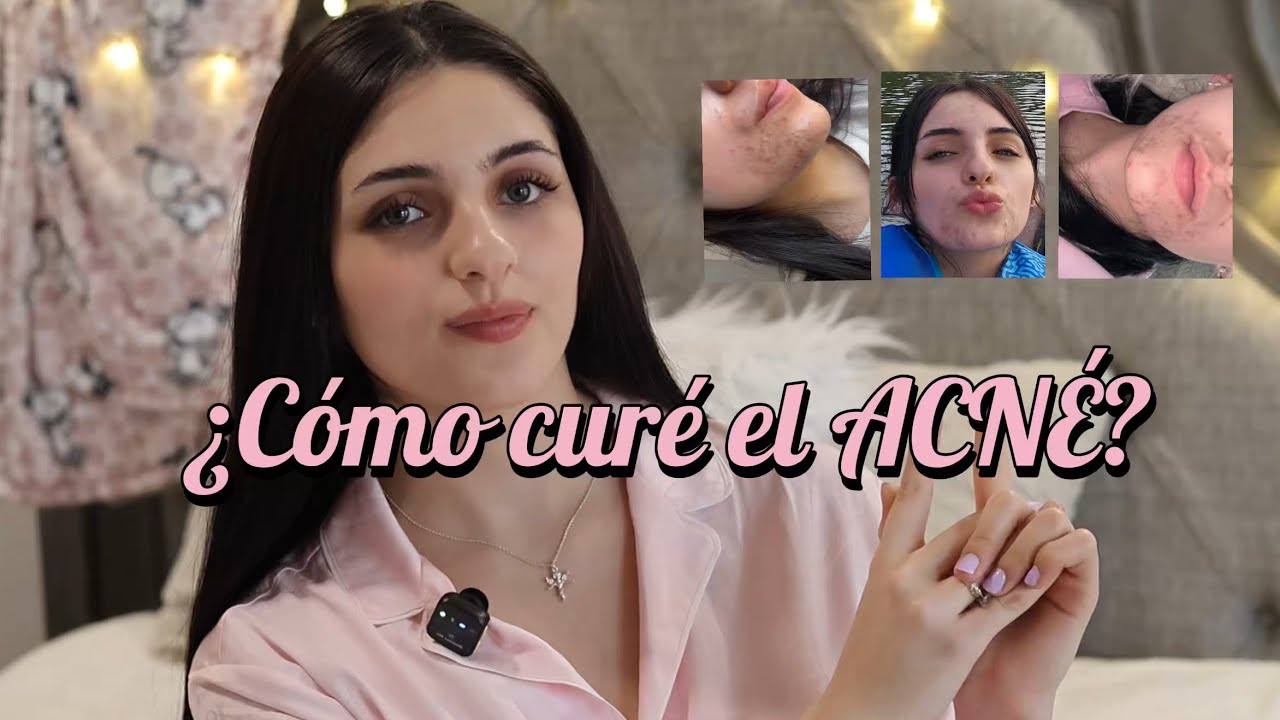 Así es como curé mi ACNÉ | Sin mentir te cuento mi experiencia real.