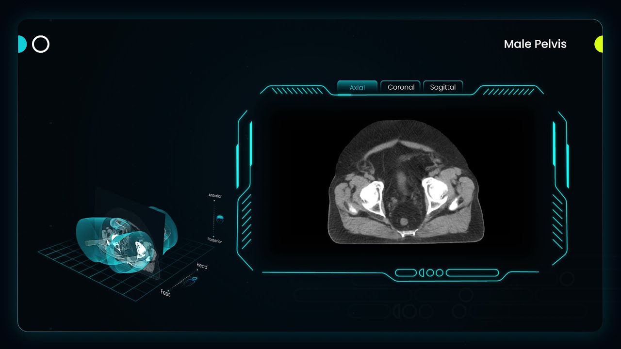 Patient #2: Prostate Cancer Treated with ClearRT&trade; Helical kVCT Imaging on the Radixact&reg; System