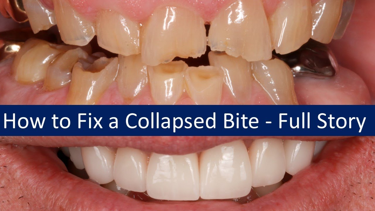 How to Fix a Collapsed Bite