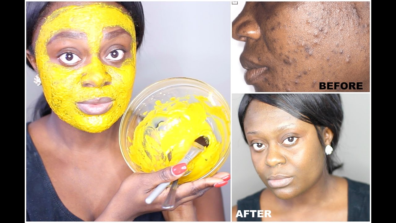 DIY TURMERIC FACE MASK | BEST ACNE TREATMENT | GET CLEAR, BRIGHT AND ACNE FREE SKIN IN 7 DAYS