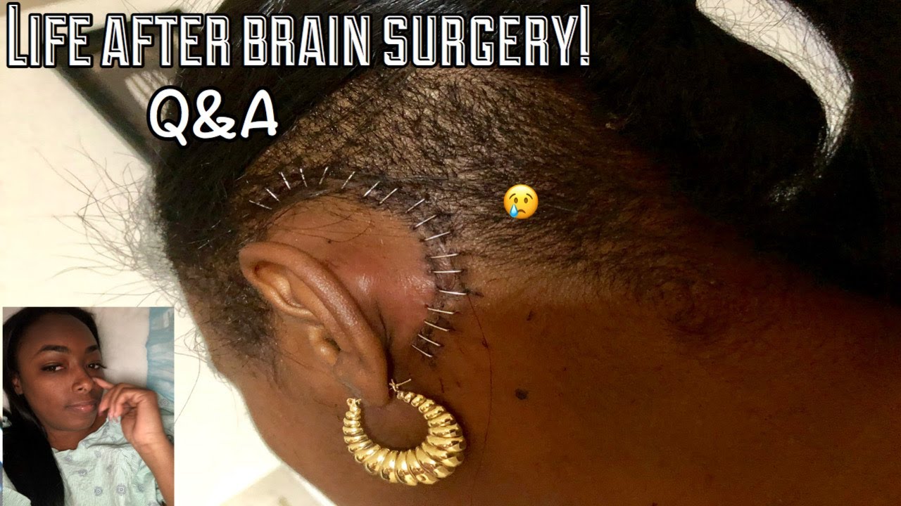 LIFE AFTER | BRAIN SURGERY | Q&A | Acoustic Neuroma | Vestibular Schwannoma | SSD | 🧠💪🏾