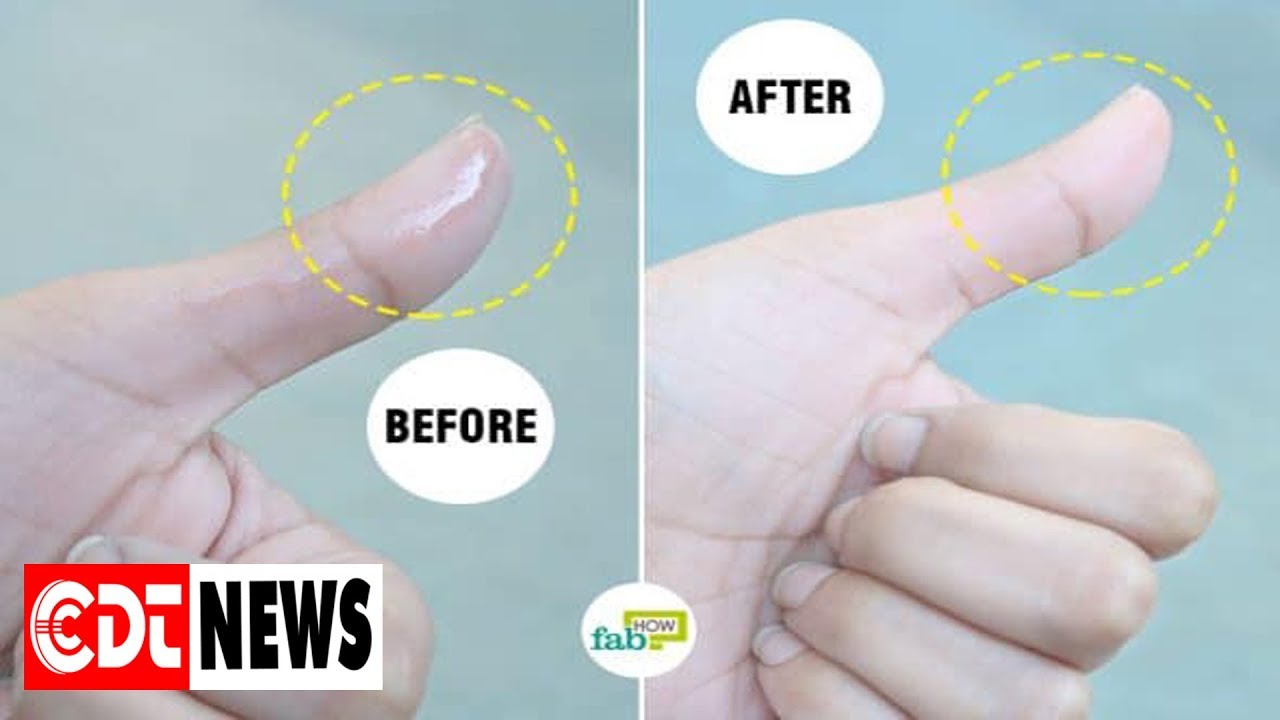 How to Remove Super Glue from Skin: 4 Methods that Work | CDT NEWS