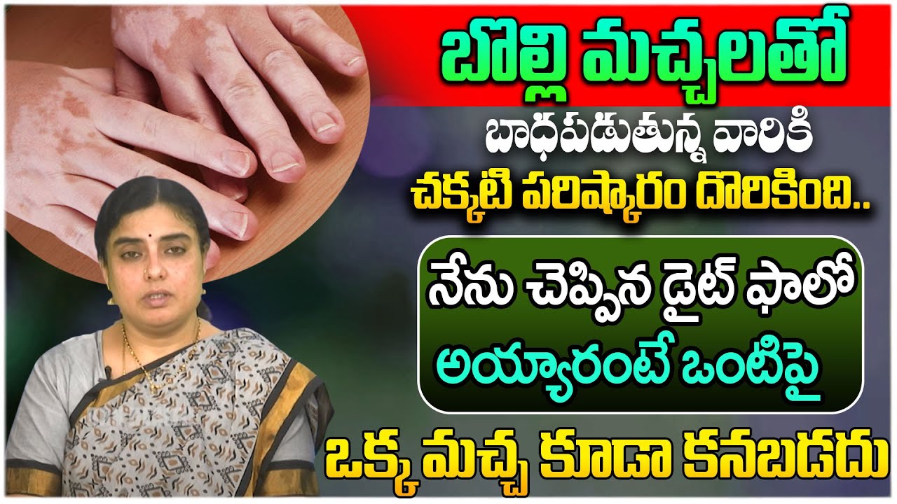 బొల్లి మచ్చలు పోవాలంటే || How to Cure Vitiligo In Telugu || Bolli Machalu || DR Satya