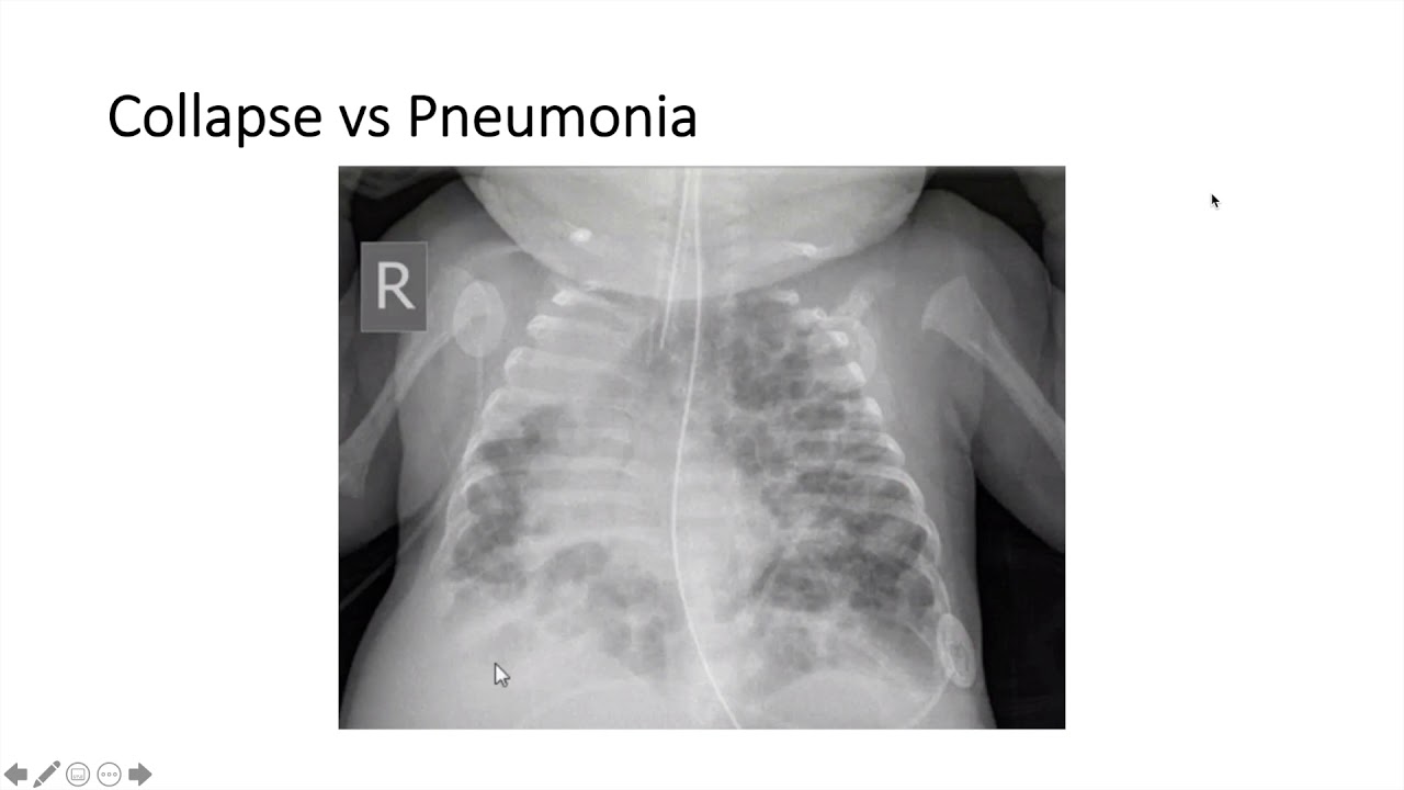 Lung Ultrasound in Neonates