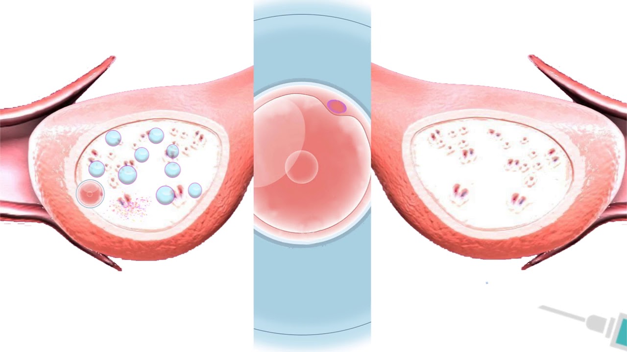 IVF Treatment Steps animation video