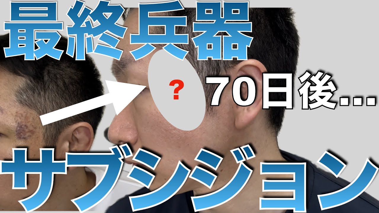 【サブシジョン】【美容皮膚科】の最終兵器うけてみた