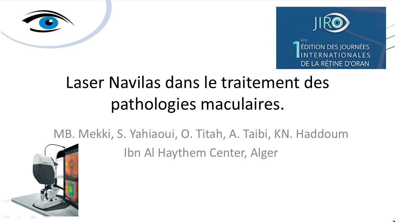 Laser Navilas dans le traitement des pathologies maculaires