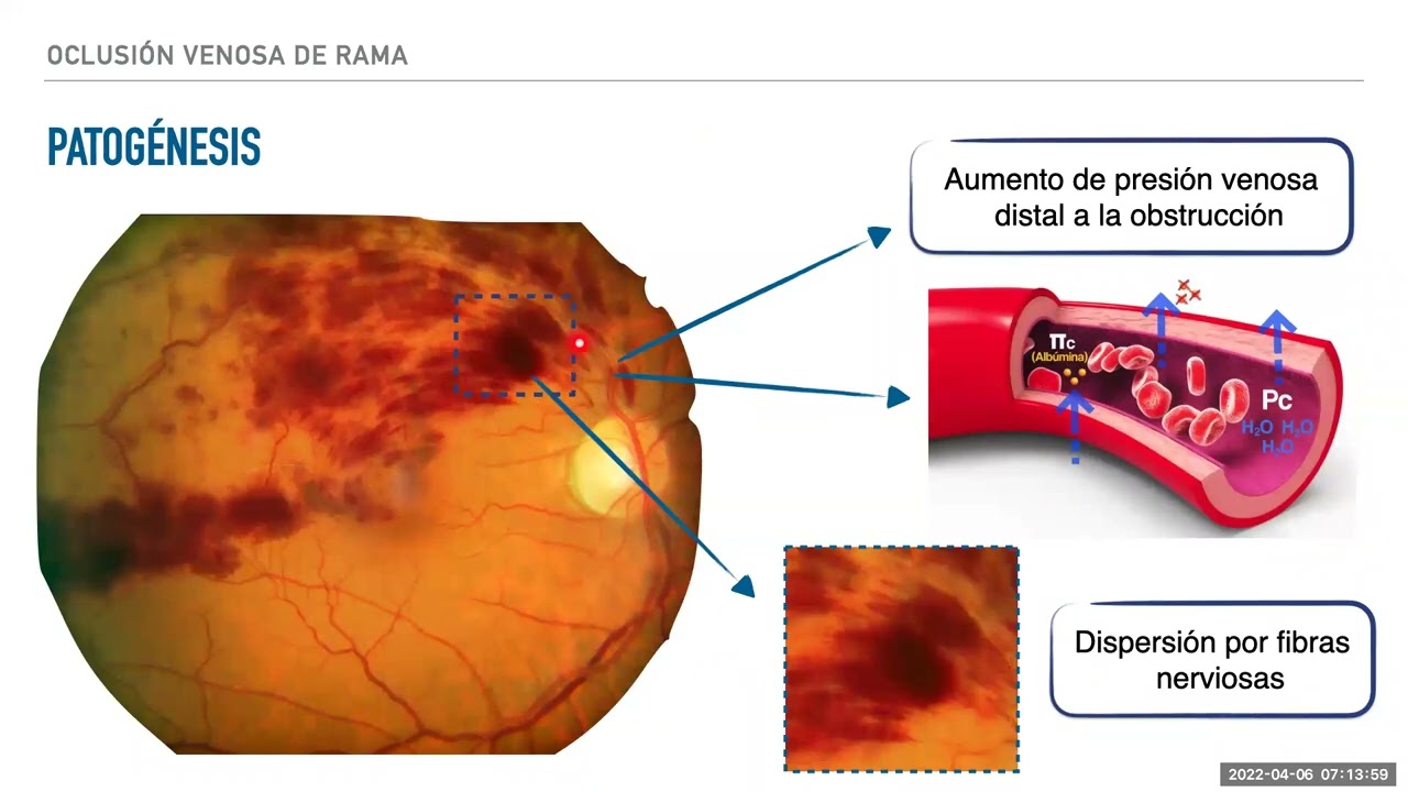 Oclusiones Venosas de Retina. Dr Marcos Restrepo. 2022_04_06