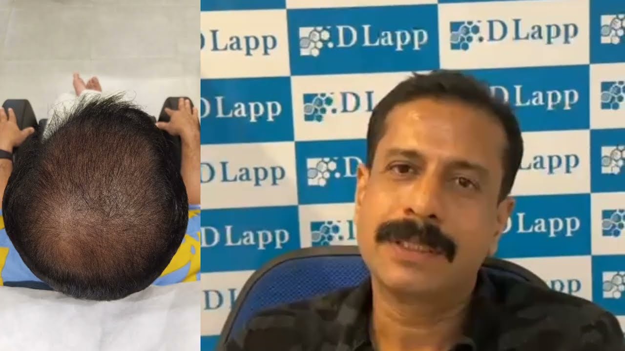 എന്റെ അനുഭവം. Dlapp കസ്റ്റമർ എക്സ്പീരിയൻസ് #dlapp #hairgrowth #alopecia #customerexperience #viral 