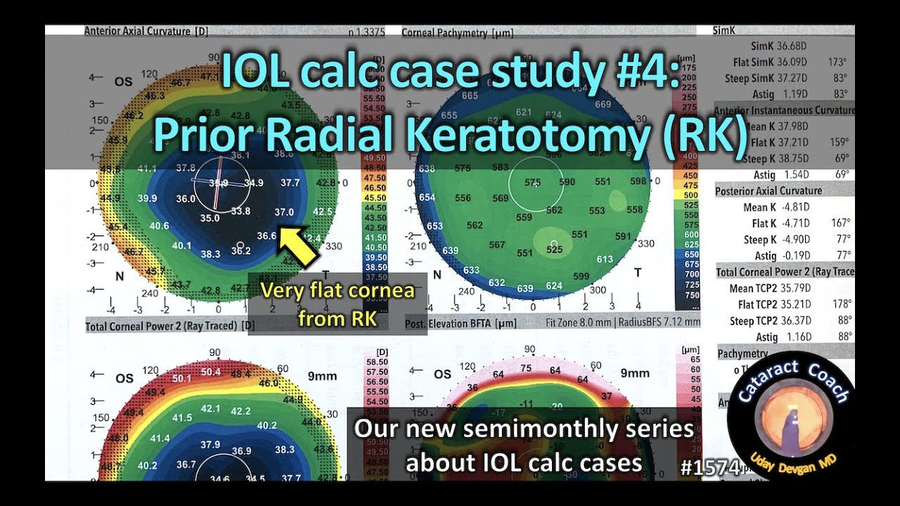 CataractCoach 1574: IOLcalc case study 4: prior Radial Keratotomy RK