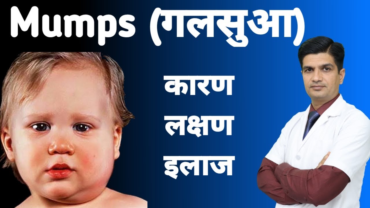 Mumps Symptoms Treatment | Galsua ka ilaj | Mumps