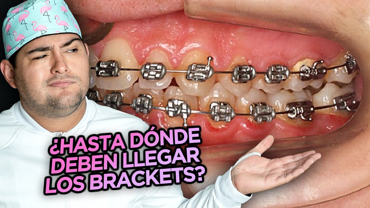 ¿HASTA QUE DIENTES LLEGAN LOS TUBOS, BANDAS Y BRACKETS DE TU ORTODONCIA?