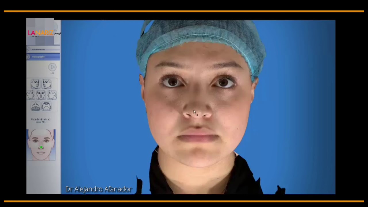 Simulacion Rinoplastia en VIVO. LANARIZ.com