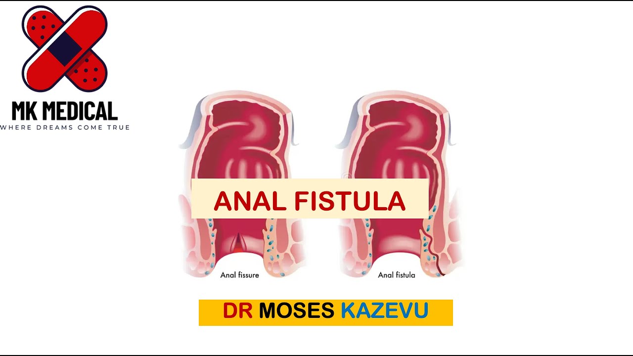 Anal Fistula