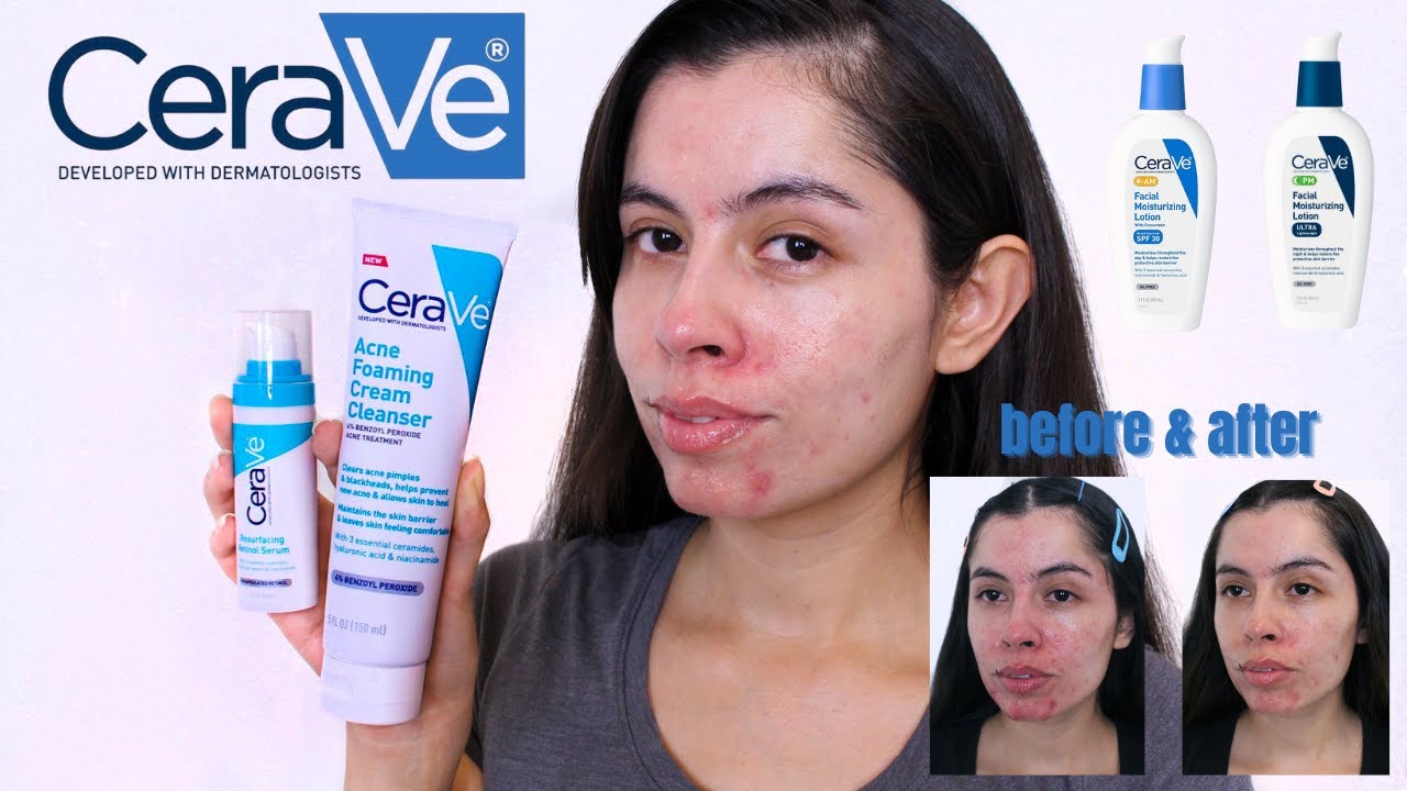 HOW I’M MANAGING MY ACNE PRONE SKIN