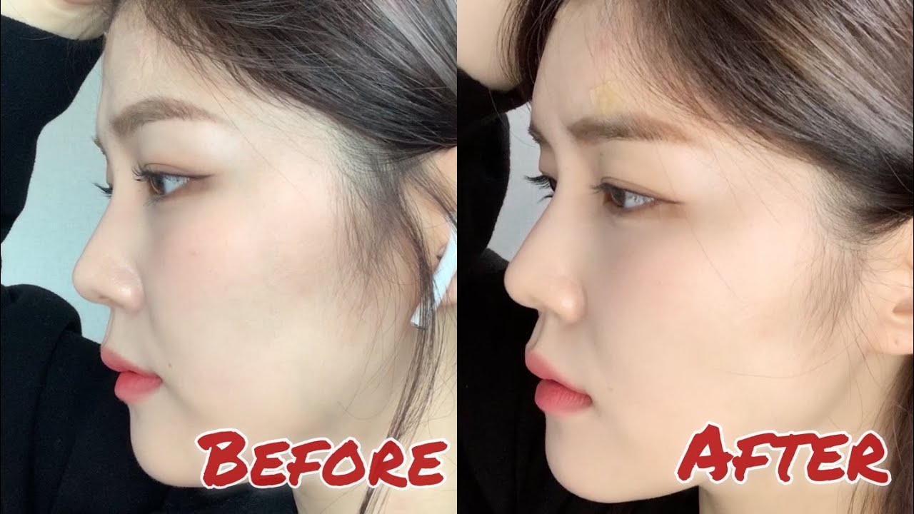 [GRWM+Vlog]  고통스러운 이마필러 후기🤦🏻‍♀│ 역대급 TMI 대방출 GRWM