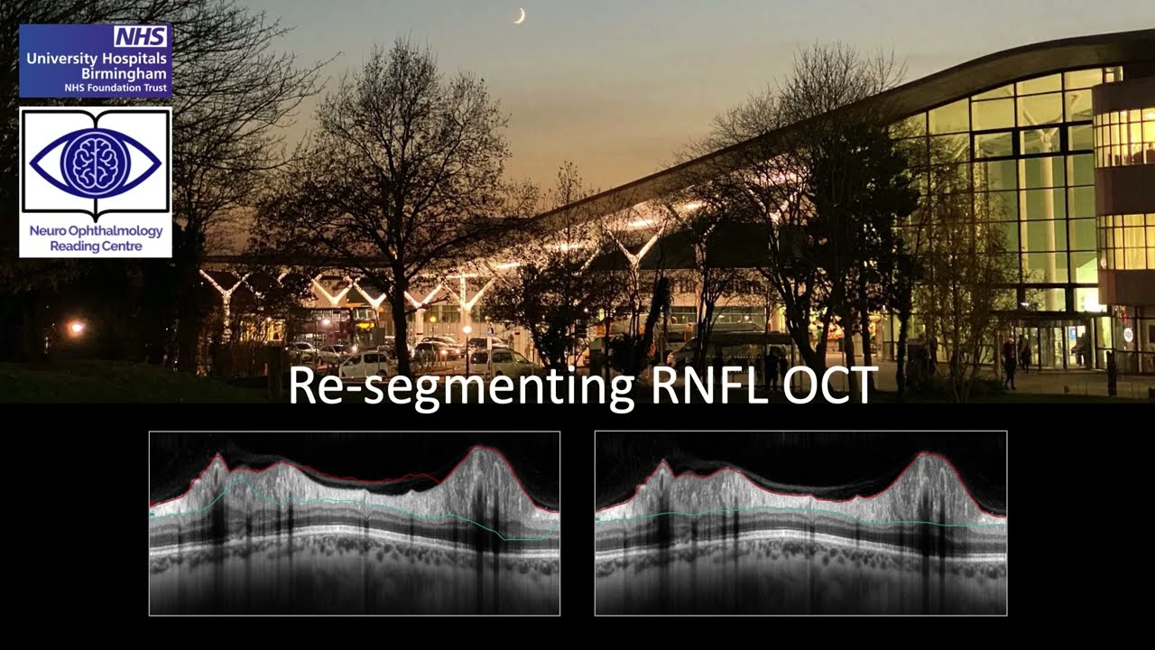 RNFL Re-segmentation for Heidelberg Spectralis