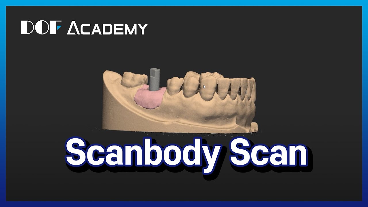 Scanbody Scan