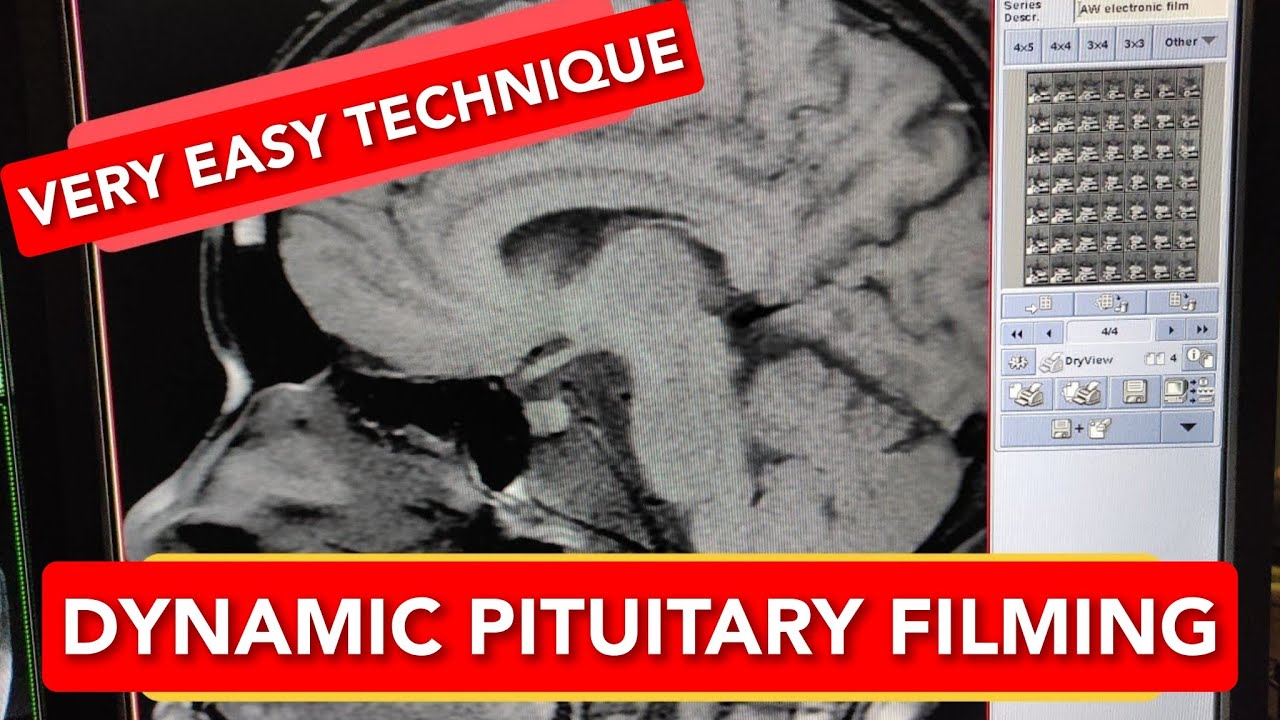 Pituitary Gland Dynamic MRI scan Filming Protocol.