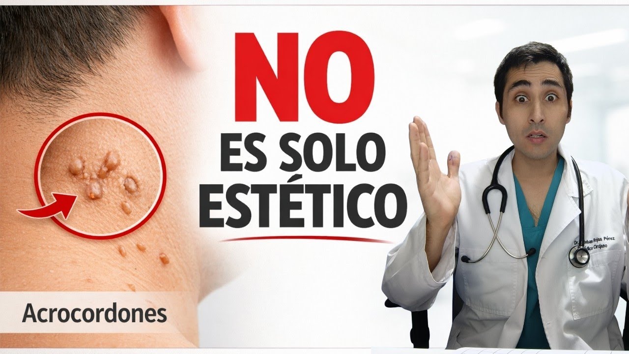 Acrocordones: qué son, por qué aparecen y cómo eliminarlos de forma segura