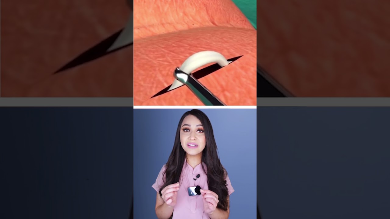 &iquest;C&oacute;mo se realiza la vasectom&iacute;a convencional?👩🏻&zwj;⚕️ #drapauzu&ntilde;iga #medicina #health #shorts #salud