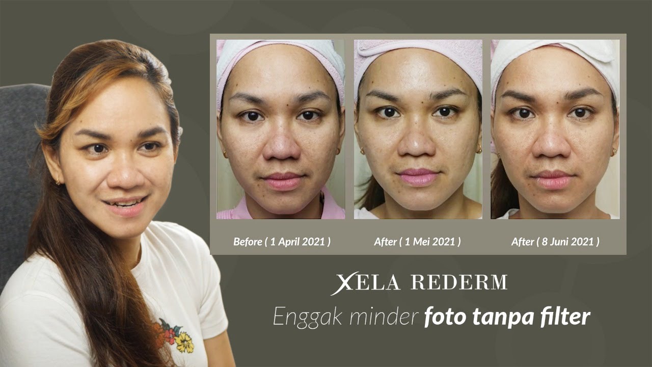 AQ Skin Solutions ft. Xela Rederm: Enggak Minder Tanpa Filter