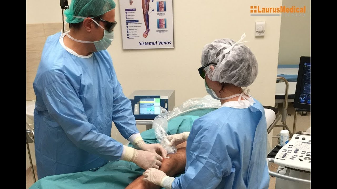 Varice - tratament cu laser endovenos 360 grade