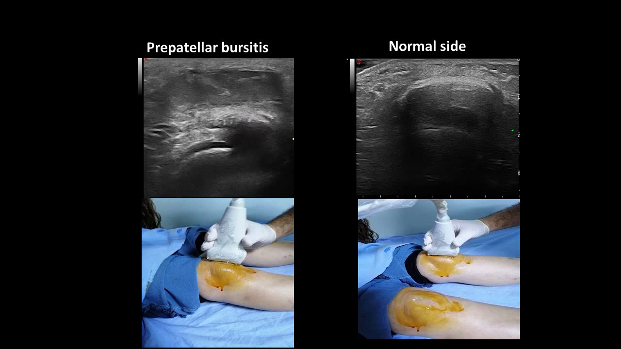 Ultrasound guided prepatellar bursitis injection  (Housemaids knee)
