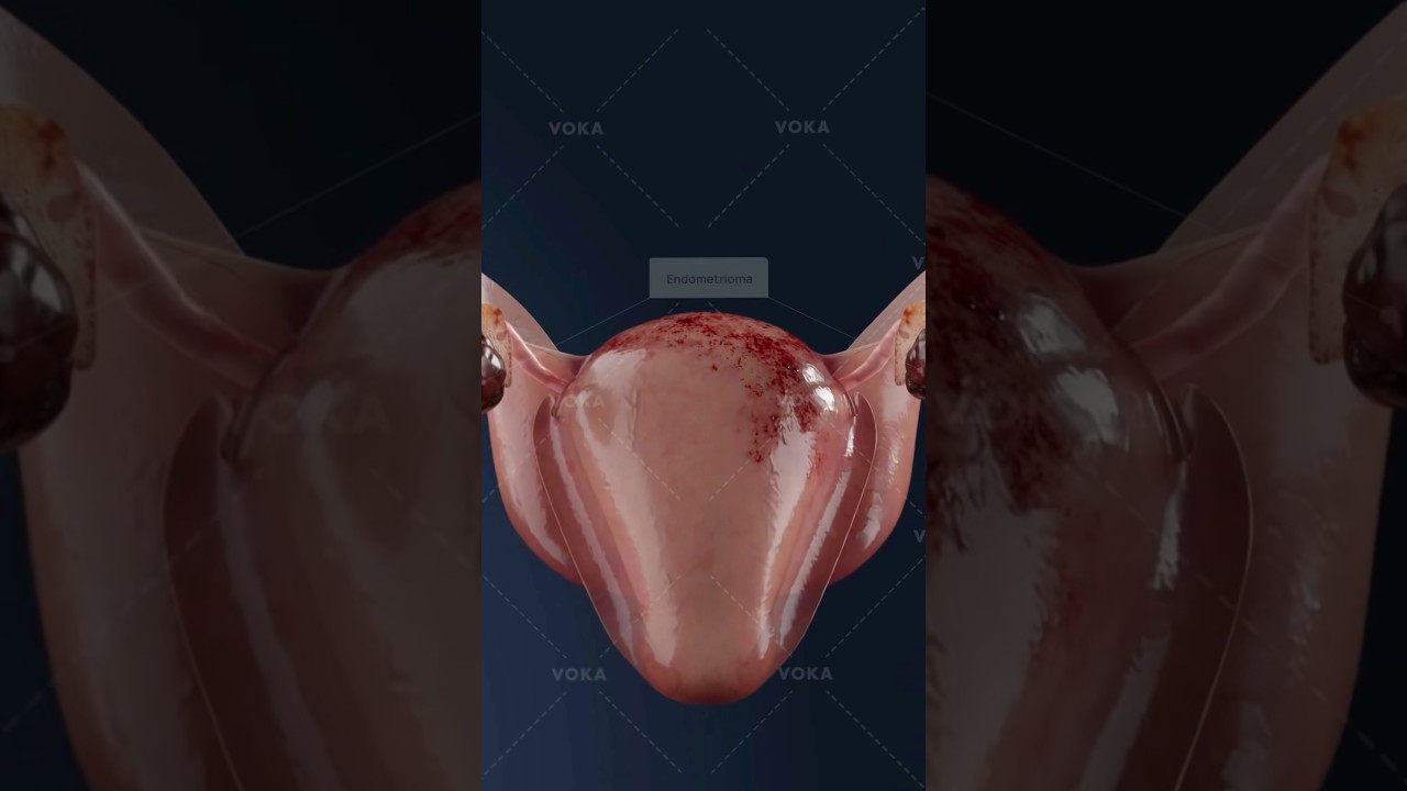 What does stage 4 endometriosis really look like inside the body? Explore gynecology in 3D