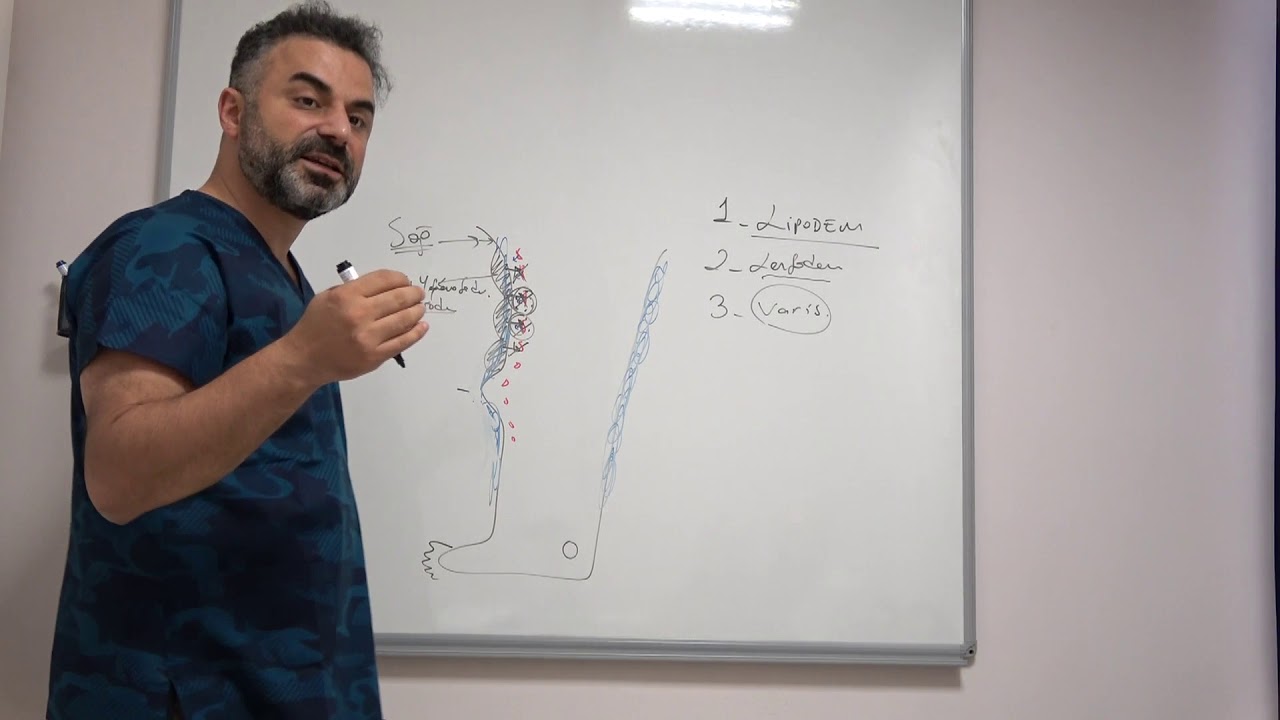 Lenfödem, Lipödem ve Varis: Tanı ve Tedavi Yöntemleri - Prof. Dr. Ahmet AKGÜL