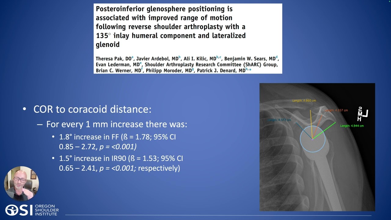 Glenosphere Sizing for Optimizing Outcomes in Reverse Shoulder Arthroplasty