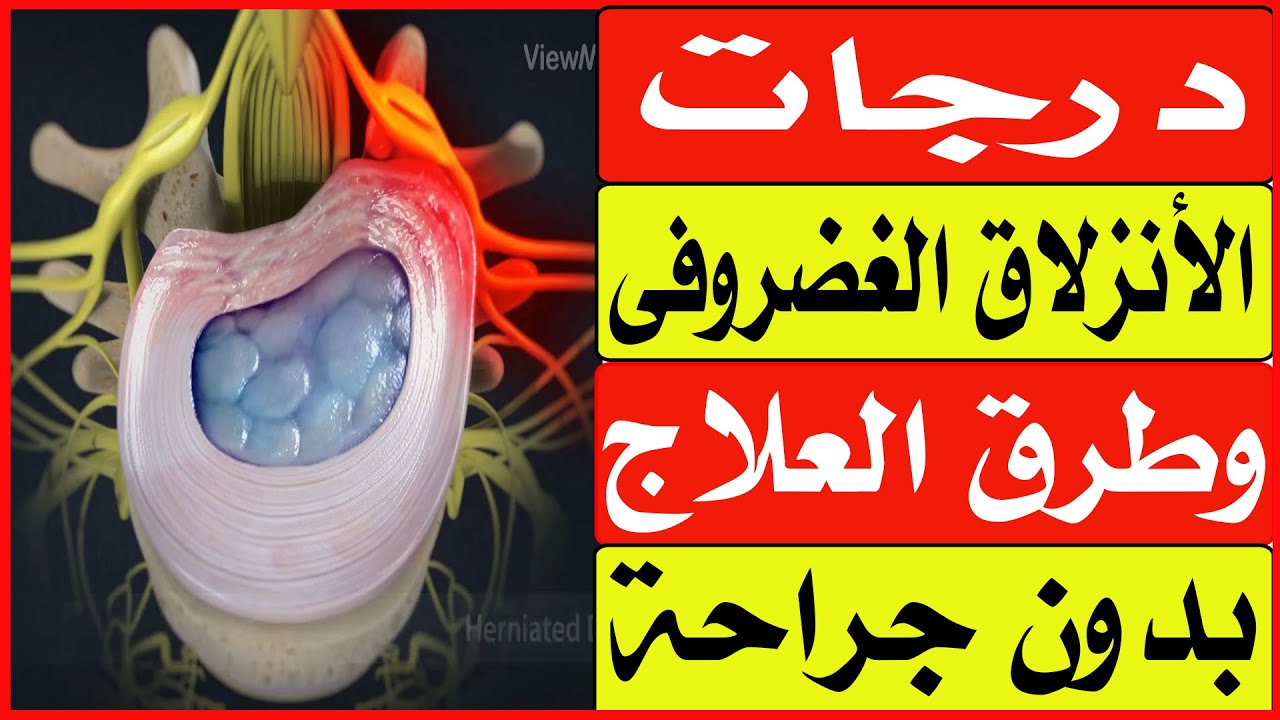درجات الأنزلاق الغضروفى وطرق العلاج بدون جراحة/ا.د.محمد حمادة أستاذ علاج الألم بطب الازهر