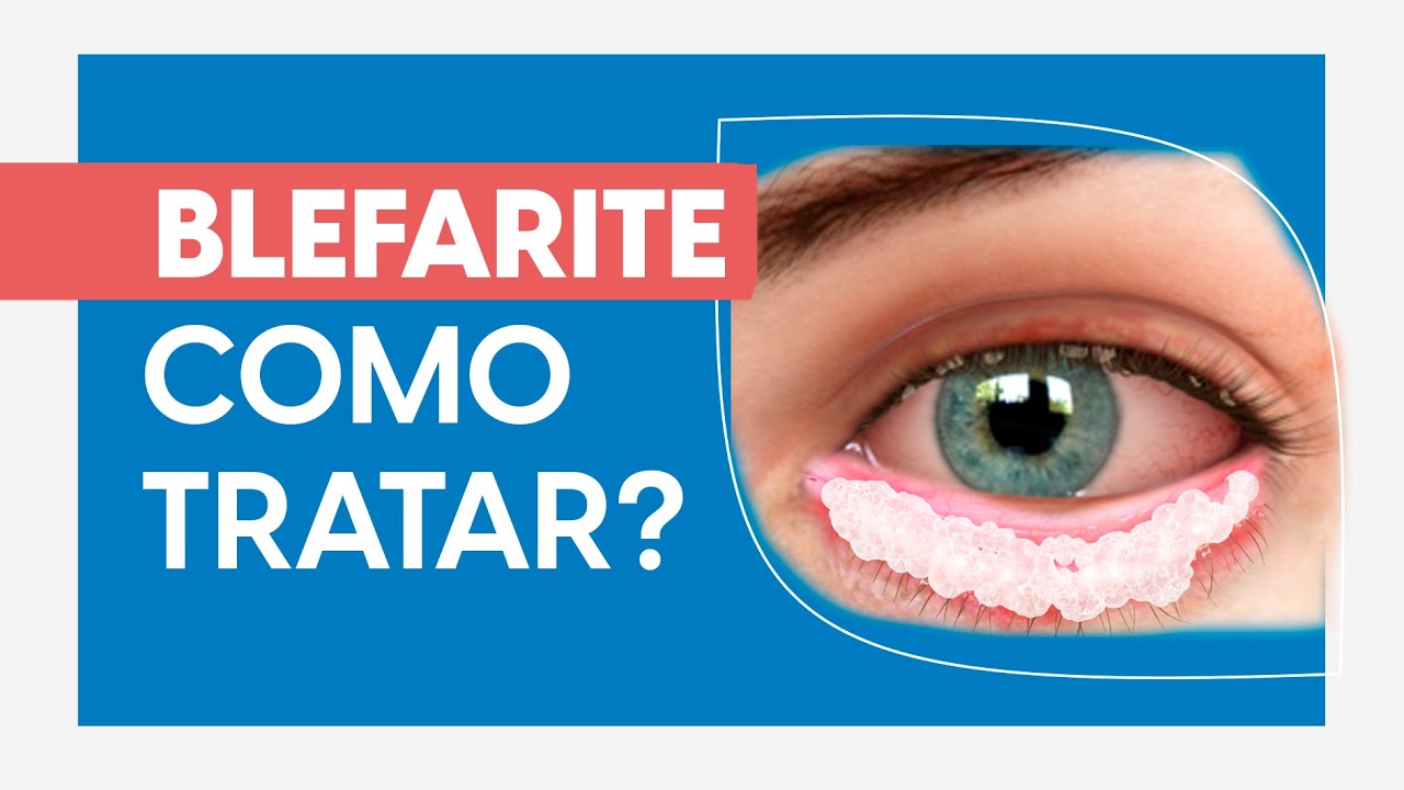 Blefarite, terçol, calázio e caspas nos cílios • Dr.Gustavo Bonfadini